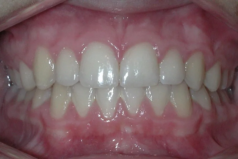Crossbite after orthodontic treatment