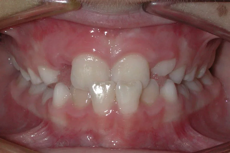 Crossbite before orthodontic treatment