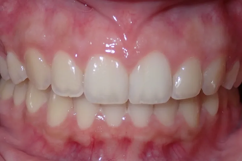 Deep Bite after orthodontic treatment