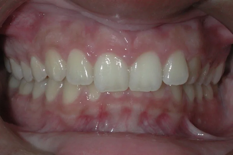 Deep Bite before orthodontic treatment