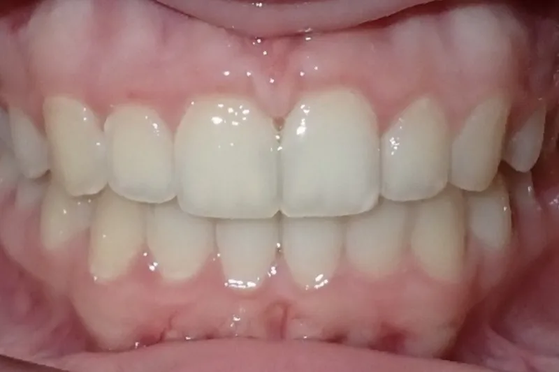 Deep Bite after orthodontic treatment