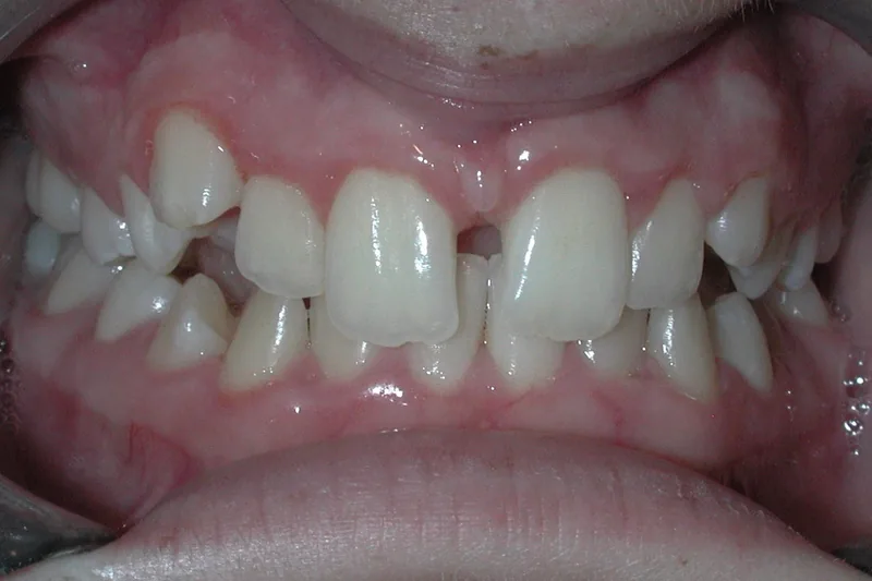 Deep Bite before orthodontic treatment