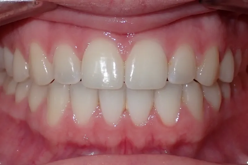 Edge to Edge Bite after orthodontic treatment