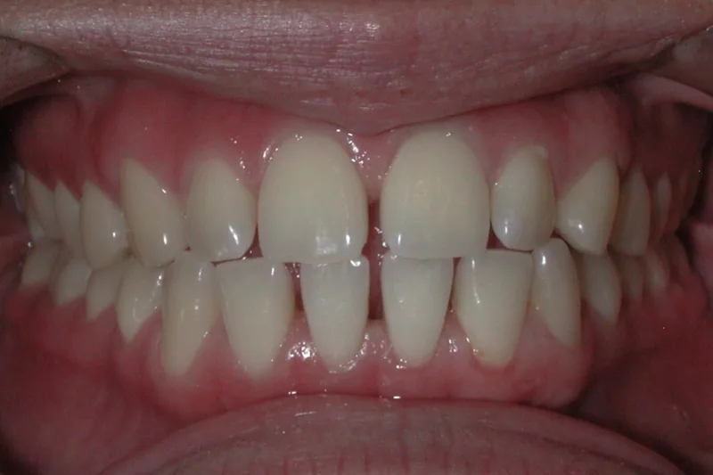 Edge to Edge Bite before orthodontic treatment