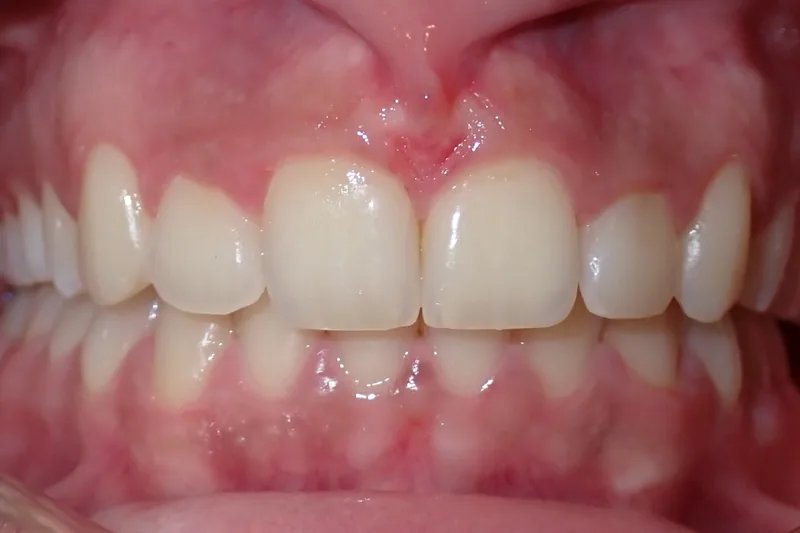 Impacted Teeth after orthodontic treatment