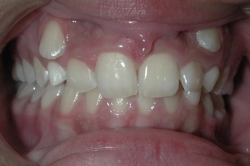Impacted Teeth before orthodontic treatment