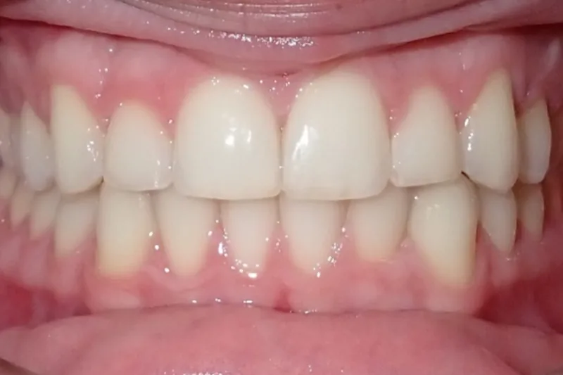 Midline Shift after orthodontic treatment
