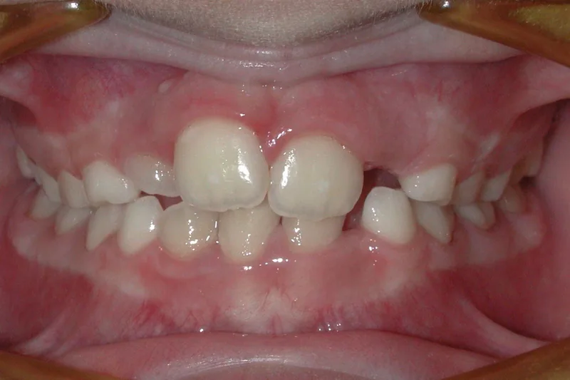 Midline Shift before orthodontic treatment