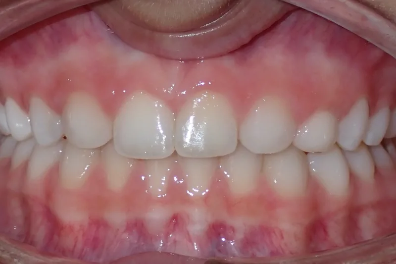 Missing Teeth after orthodontic treatment