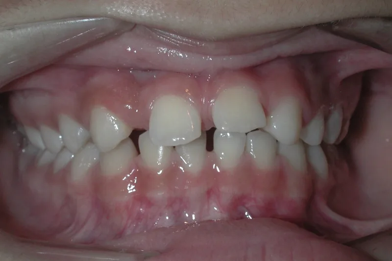 Missing Teeth before orthodontic treatment