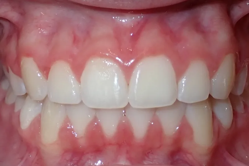 Narrow Arch/Expansion after orthodontic treatment