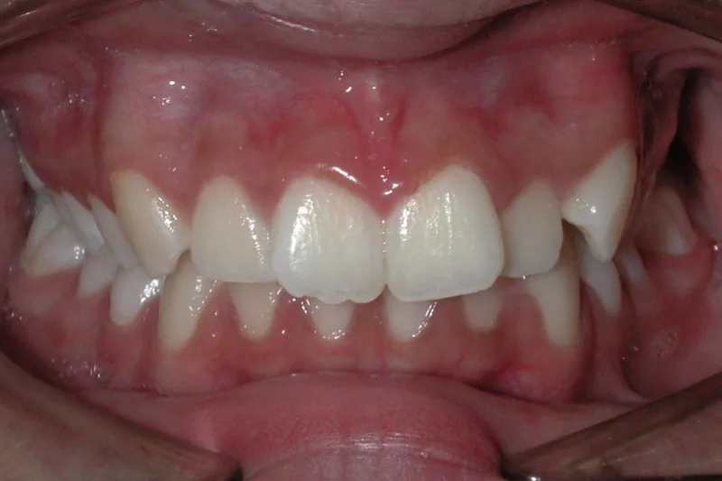 Narrow Arch/Expansion before orthodontic treatment