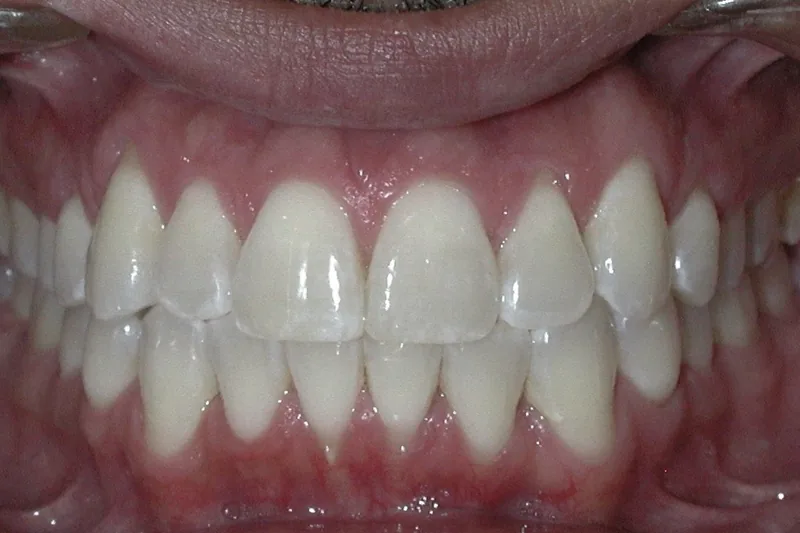 Open Bite after orthodontic treatment