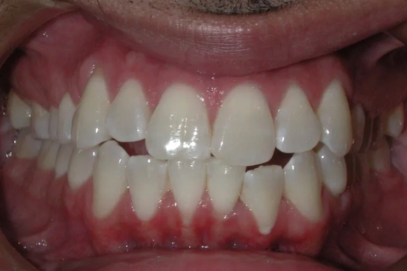 Open Bite before orthodontic treatment