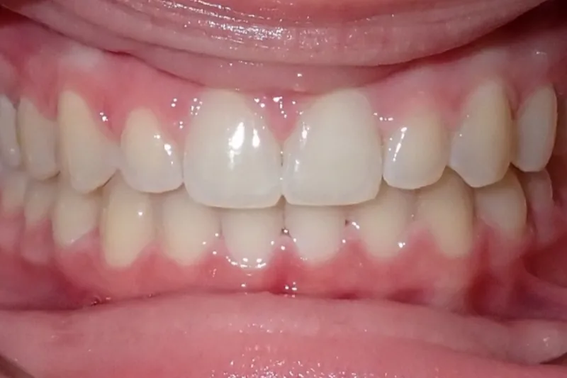 Open Bite after orthodontic treatment