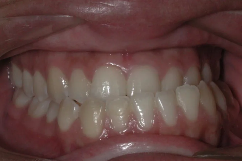 Orthognathic Surgery before orthodontic treatment