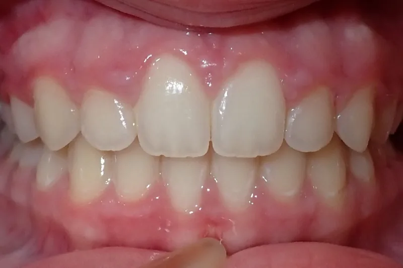 Overjet/Flared Teeth after orthodontic treatment