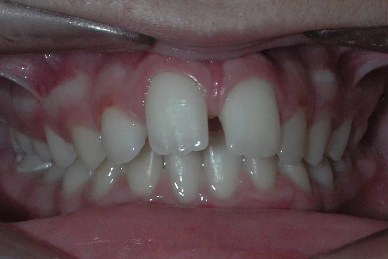 Overjet/Flared Teeth before orthodontic treatment