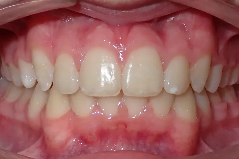 Posterior Crossbite after orthodontic treatment