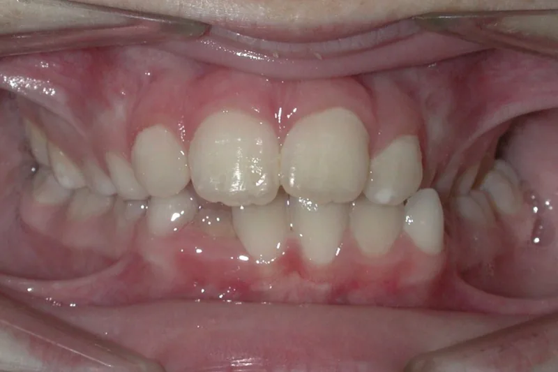 Posterior Crossbite before orthodontic treatment