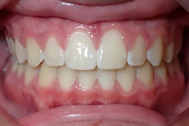 Spaces after orthodontic treatment