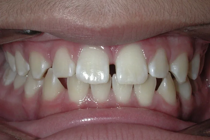 Spaces before orthodontic treatment