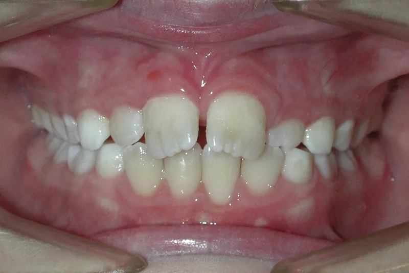 Spaces before orthodontic treatment