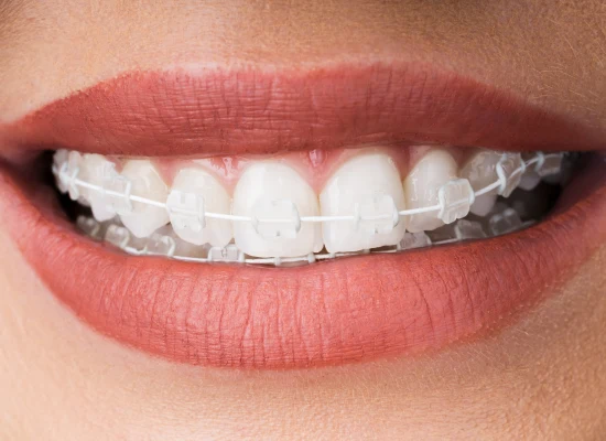 Ceramic clear braces