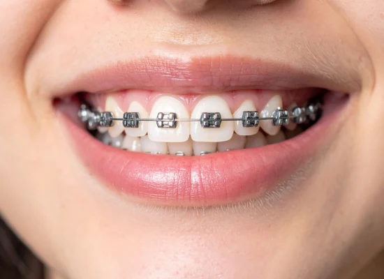 Metal braces