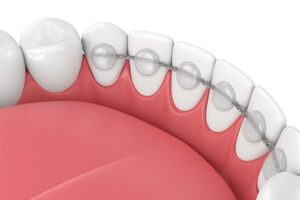 Bonded permanent retainer wire on the back of front teeth