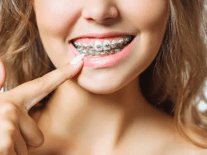 Braces improving jaw alignment at Torres Orthodontics in Tampa, Miami Lakes, and Boca Raton, FL