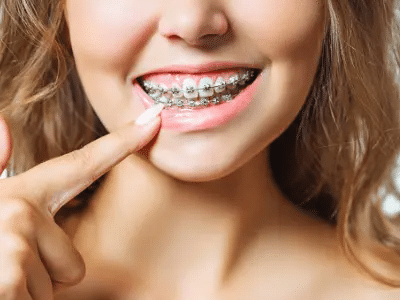 Braces improving jaw alignment at Torres Orthodontics in Tampa, FL