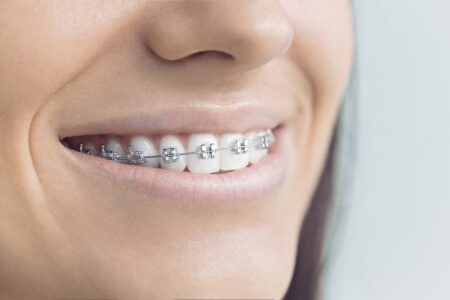 Value of Affordable Braces Torres Orthodontics in Tampa, Miami Lakes, and Boca Raton, FL