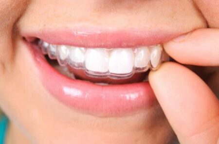 5 Home Care Hacks for Clear Aligners at Torres Orthodontcs in Tampa, Miami Lakes, and Boca Raton, FL.