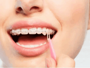 Why Do I need To Wear Elastics?